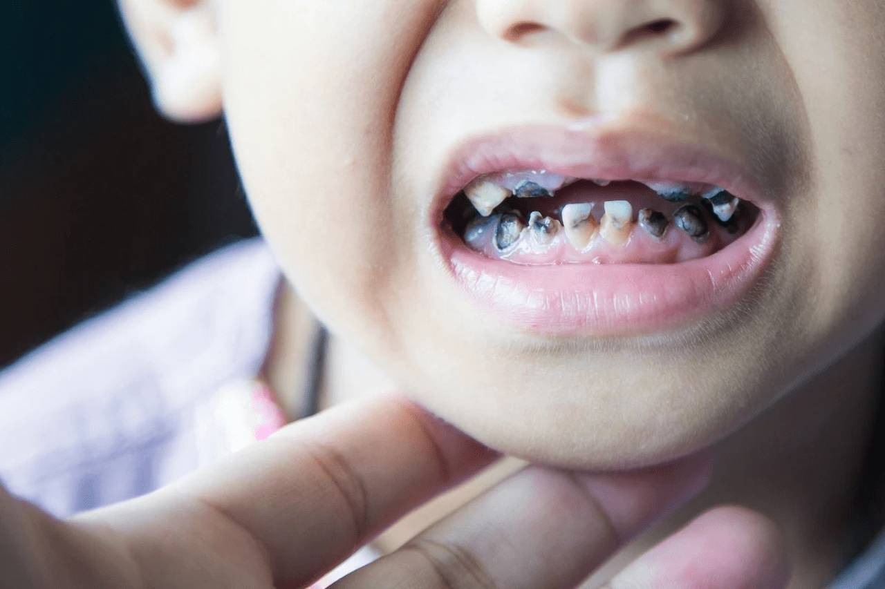 Sâu răng là bệnh lý rất phổ biến ở trẻ nhỏ